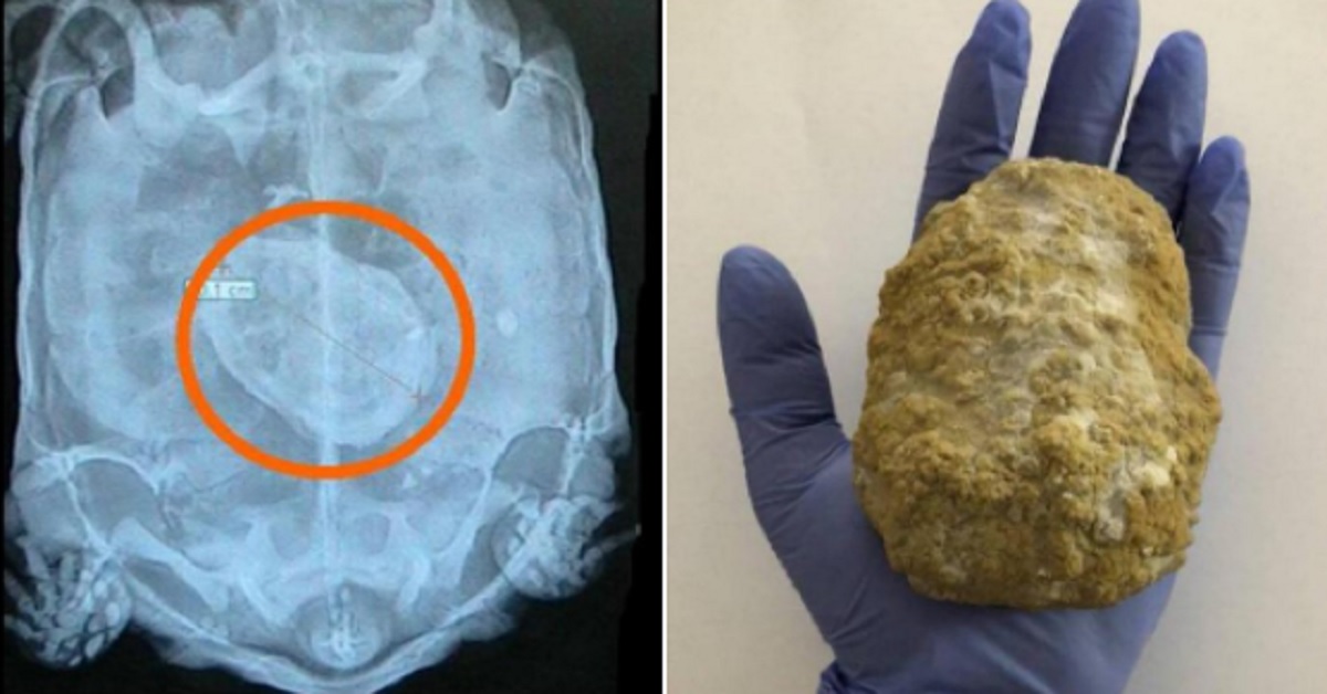 A Tortoise Bladder Stone